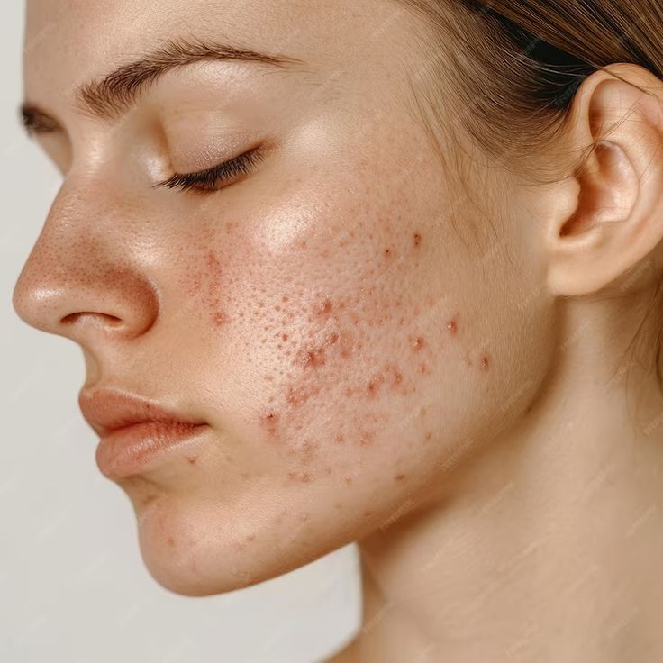 Acne and Pigmentation Explained. Causes, Solutions and the Skincare That Truly Helps